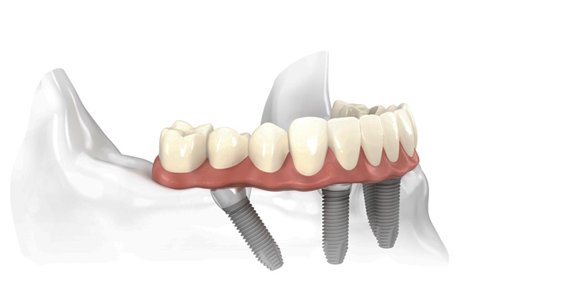 Ponte Fixa sobre Implantes Dentários na PERFECT SMILE